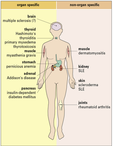 Autoimmunity And Autoimmune Disease Oncohema Key