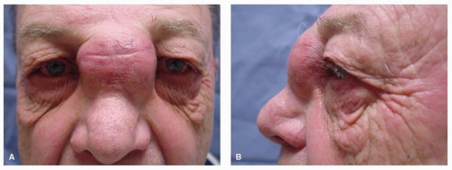Cancer Of The Nasal Cavity And The Paranasal Sinuses Oncohema Key 0668