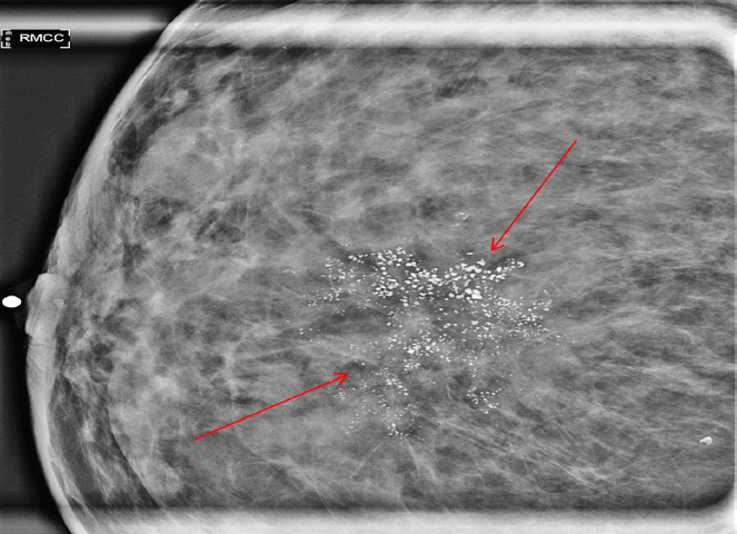 Management Of Ductal Carcinoma In Situ Oncohema Key