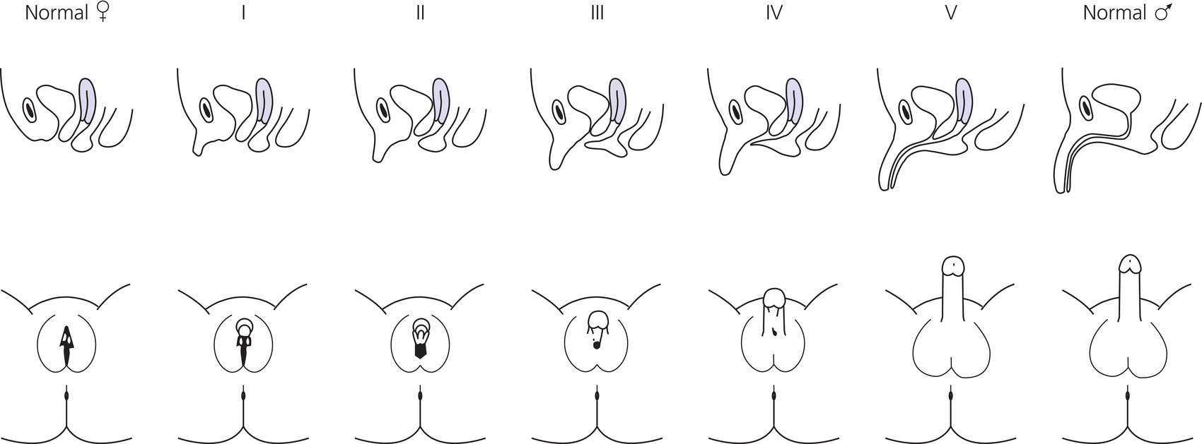 14 Illustrations displaying the Prader system for classifying ambiguous external genitalia, with grades I – V (left to right) describing the increasing stages of virilization between female phenotype at one end of the spectrum and a male phenotype at the other end.