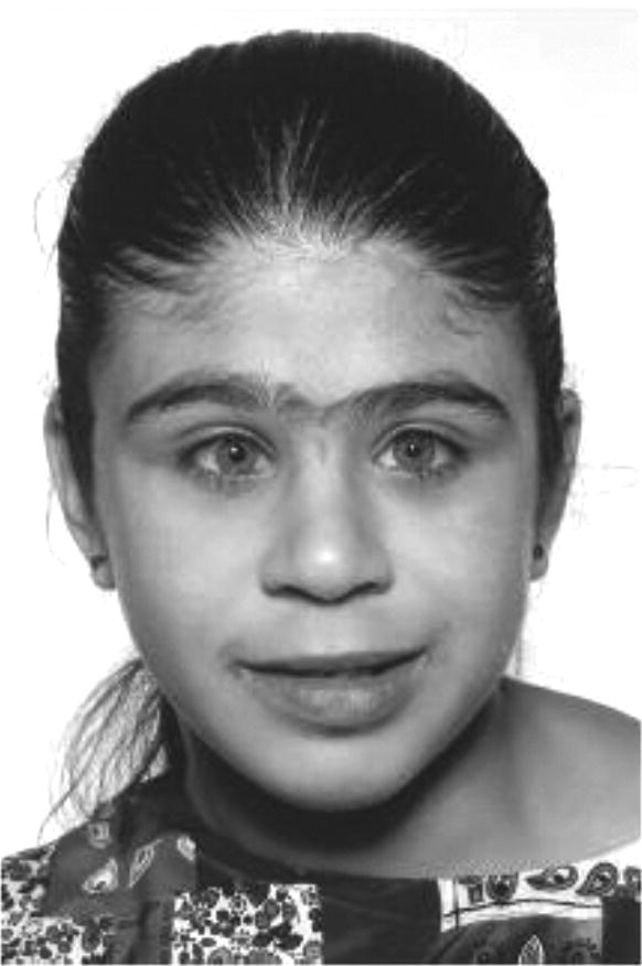 Photo of a girl with Williams syndrome.