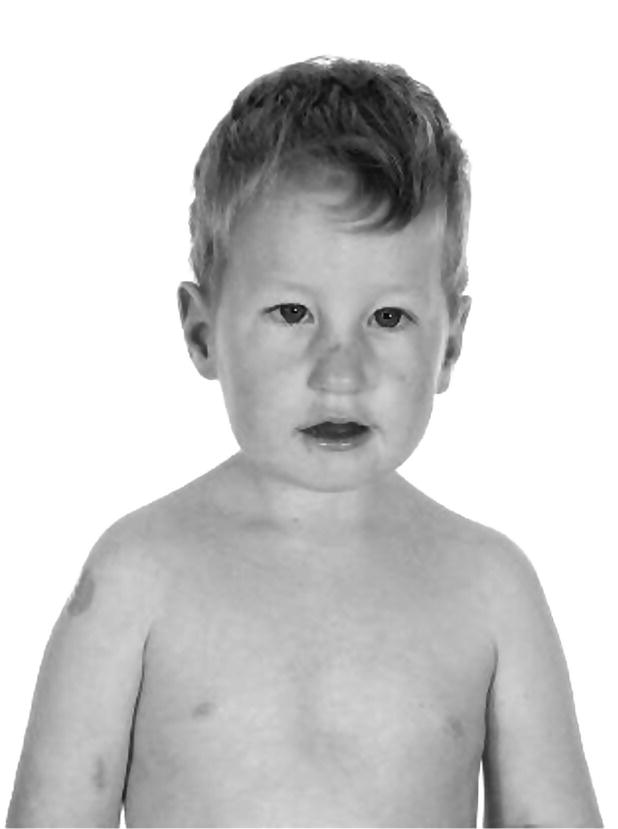 Photo of a boy with Prader–Willi syndrome.