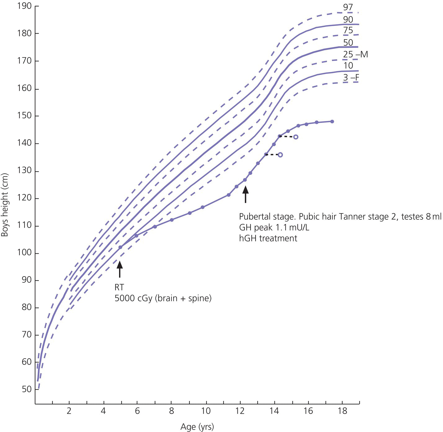 Graph of boys height vs. age depicting coinciding ascending dashed and solid curves with arrows pointing labeled RT 5000 cGy (brain + spine) and Pubertal stage. Pubic hair Tanner stage 2, testes 8mL, GH peak 1.1 mU/L, hGH treatment.