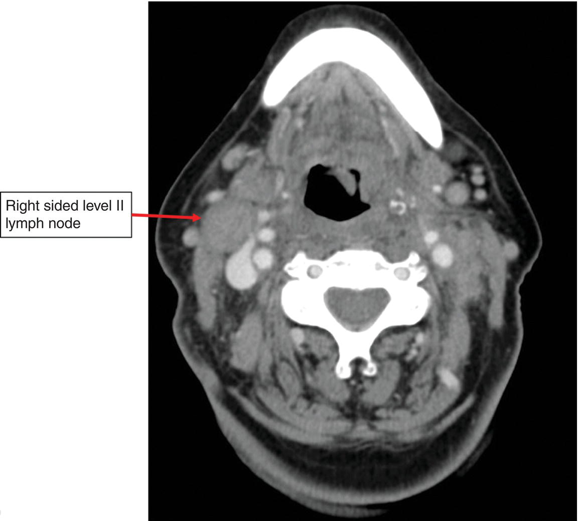 Photo depicts axial CT scan showing enlarged right upper jugular Level II lymph node measuring 2.5 cm in greatest dimension.