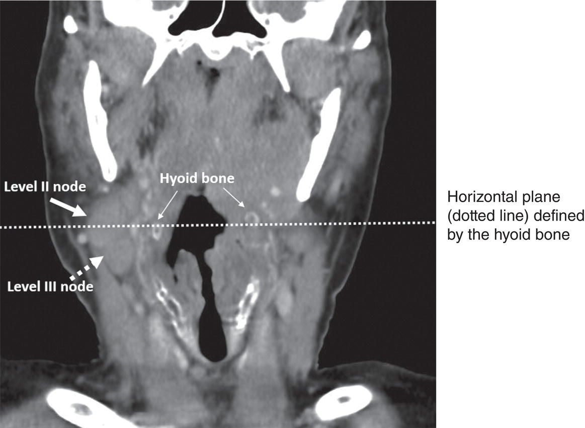 Photo depicts coronal CT scan showing the same enlarged right upper jugular Level II lymph node measuring 2.5 cm in greatest dimension, but also an enlarged right medial jugular Level III lymph node measuring 1.5 cm in greatest dimension.