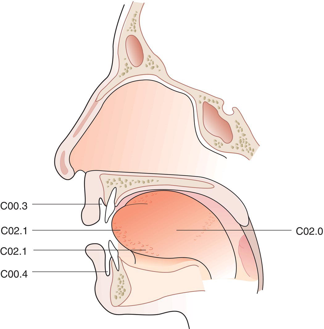 Schematic illustration of the indications of Buccal mucosa, Upper alveolus and gingiva, Lower alveolus and gingiva, Hard palate, and tongue.