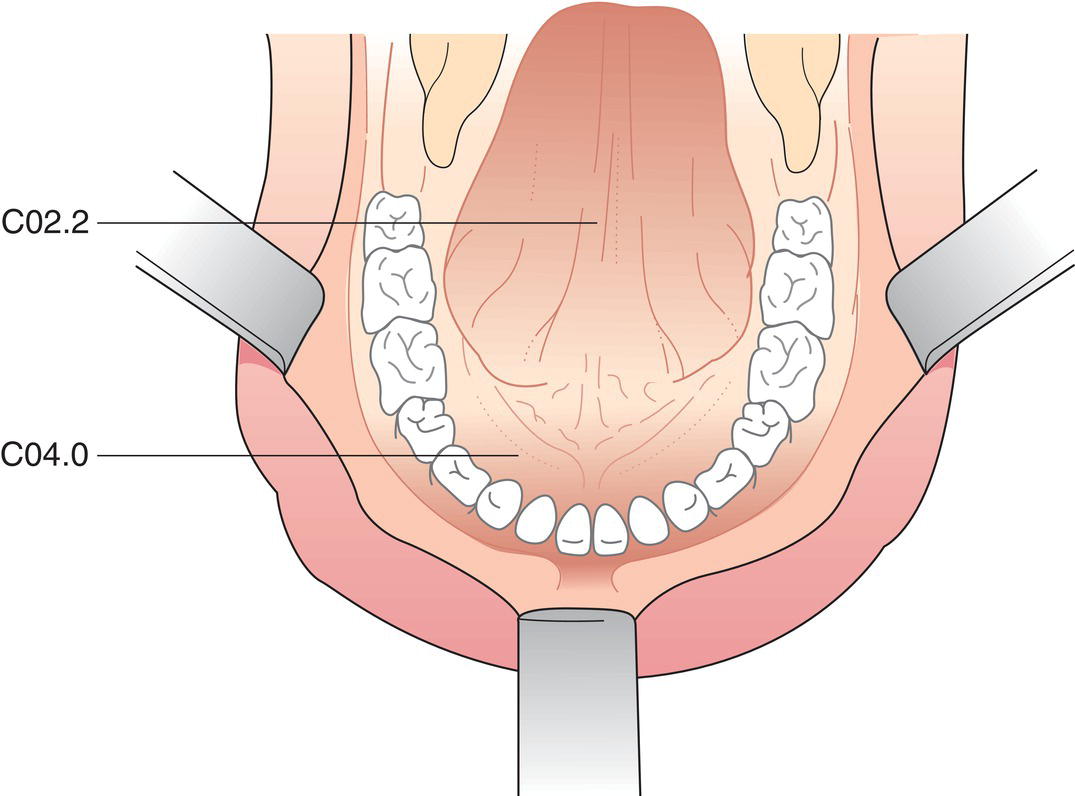 Schematic illustration of the indications of Buccal mucosa, Upper alveolus and gingiva, Lower alveolus and gingiva, Hard palate, and tongue.