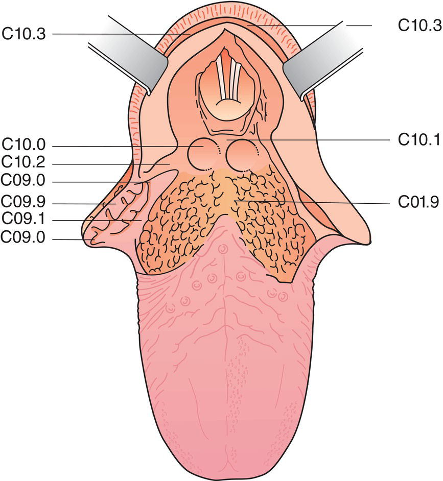 Schematic illustration of Posterior wall, Vallecula, Posterior wall, Tonsil, Glossotonsillar sulci (tonsillar pillars), Tonsillar fossa and tonsillar (faucial) pillars