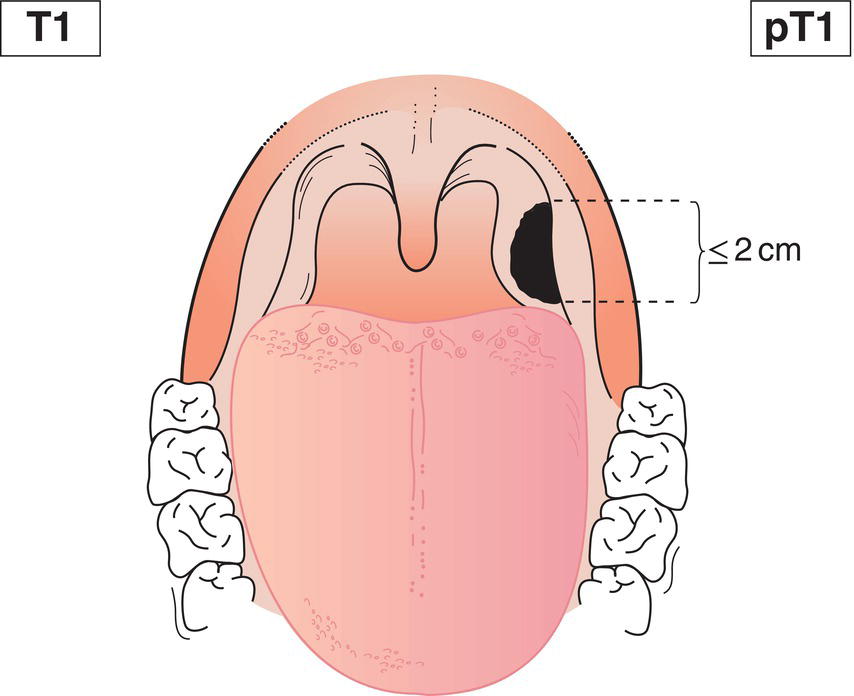 Schematic illustration of tumour 2 cm or less in greatest dimension.