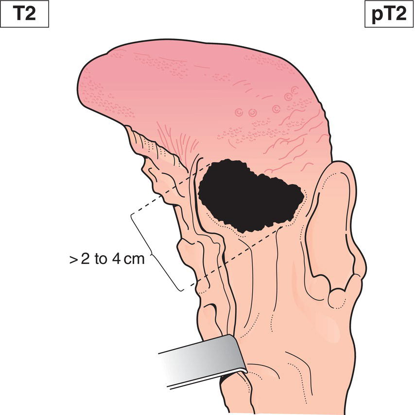 Schematic illustration of tumour more than 2 cm but not more than 4 cm in greatest dimension.