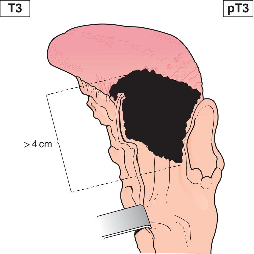 Schematic illustration of tumour more than 4 cm in greatest dimension or extension to lingual surface of epiglottis.