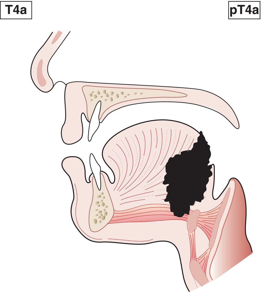 Schematic illustration of tumour invades any of the following: larynx, deep or extrinsic muscle of tongue, medial pterygoid,
hard palate or mandible.