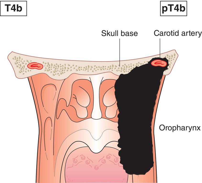 Schematic illustration of tumour invades lateral pterygoid muscle, pterygoid plates, lateral nasopharynx, skull base; or encases carotid artery.