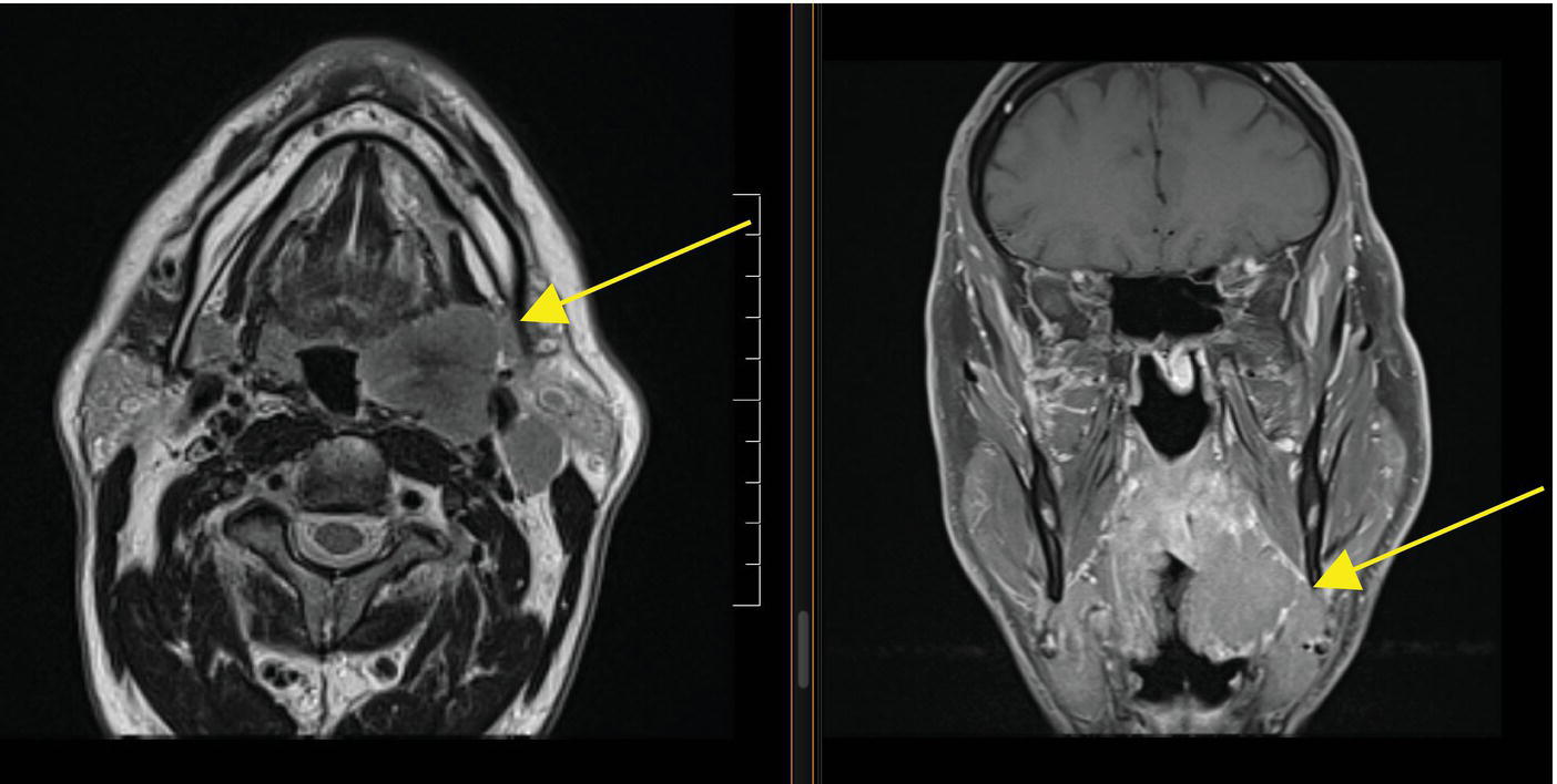 Photo depicts an MRI of an HPV-positive T4 tonsil lesion extending into the parapharyngeal space.