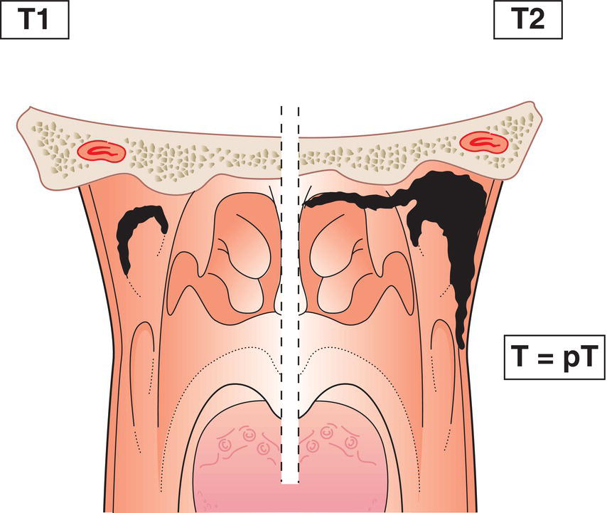 Schematic illustration of tumour confined to nasopharynx, or extends to oropharynx and nasal cavity.