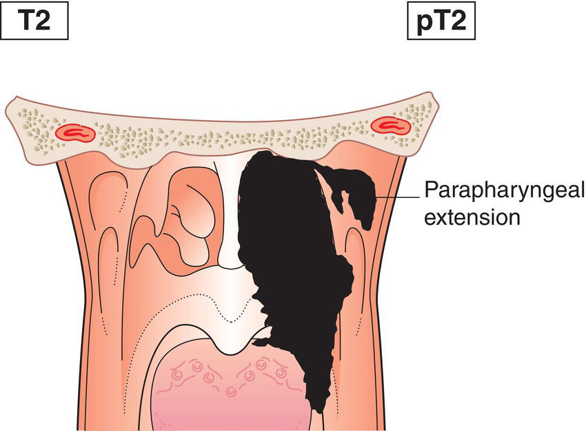 Schematic illustration of tumour with extension to parapharyngeal space and infiltration of the medial
pterygoid, lateral pterygoid and prevertebral muscles.