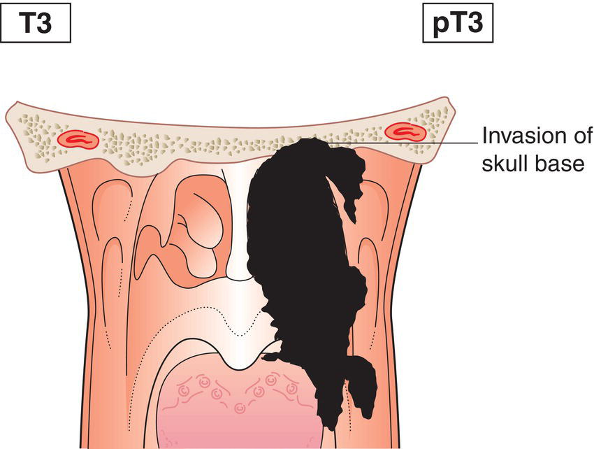 Schematic illustration of tumour invades bony structures of skull base cervical vertebra, pterygoid structures
and paranasal sinuses.