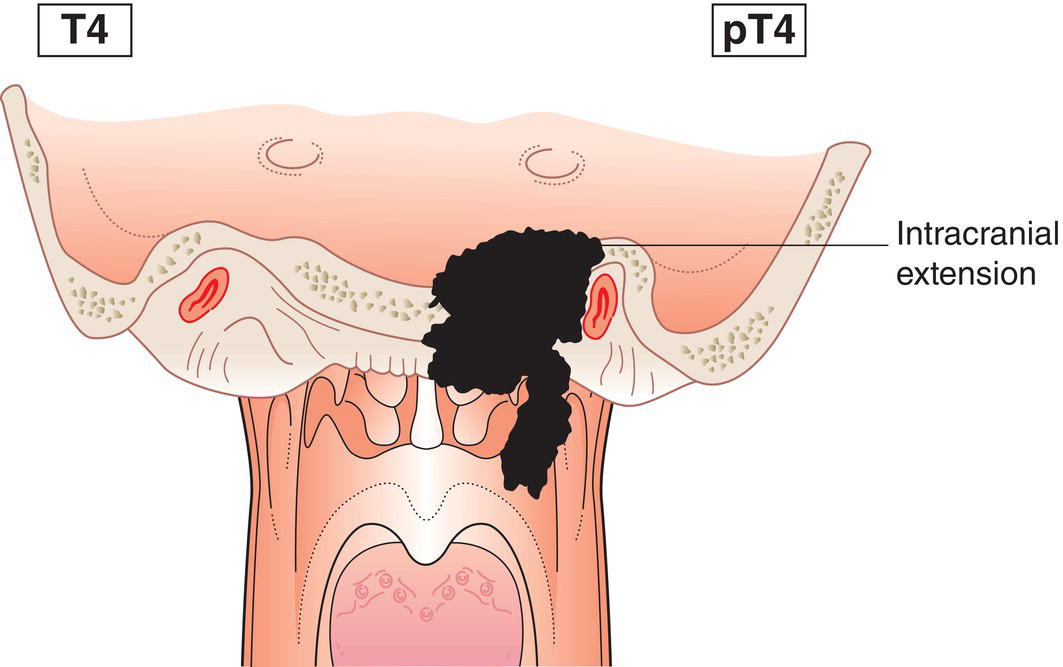 Schematic illustration of tumour with intracranial extension and involvement of cranial nerves,
hypopharynx, orbit, parotid gland and infiltration beyond the lateral surface of
the lateral pterygoid muscle.