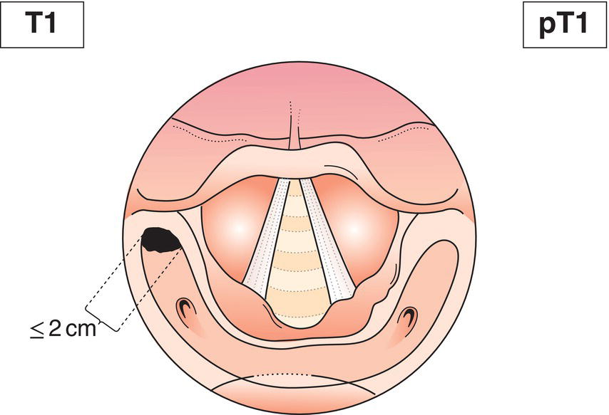 Schematic illustration of tumour limited to one subsite of hypopharynx and 2 cm or less
in greatest dimension.