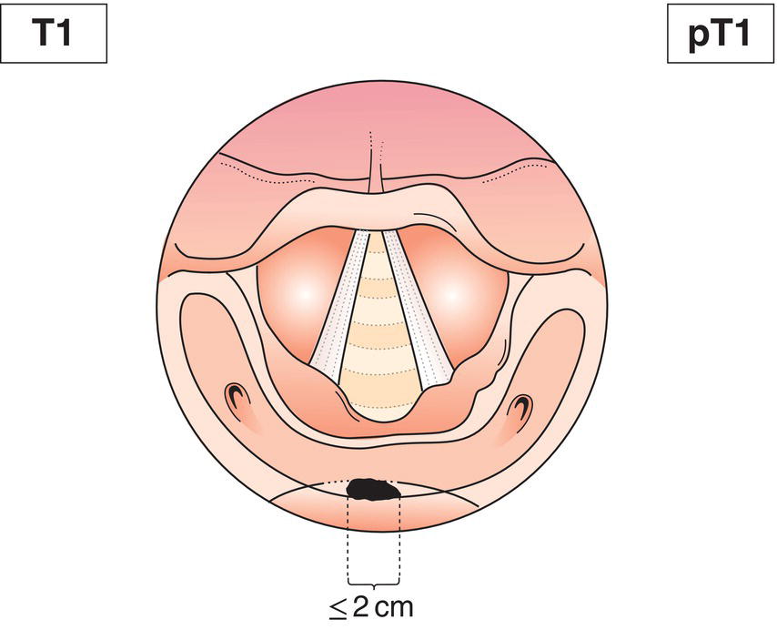 Schematic illustration of tumour limited to one subsite of hypopharynx and 2 cm or less
in greatest dimension.