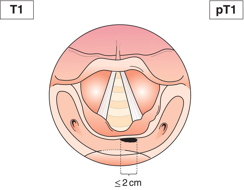 Schematic illustration of tumour limited to one subsite of hypopharynx and 2 cm or less
in greatest dimension.