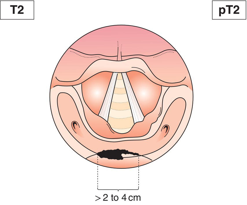 Schematic illustration of tumour invades more than one subsite of hypopharynx or an adjacent site, or measures more than 2 cm but not more than 4 cm in greatest dimension, without fixation of hemilarynx.