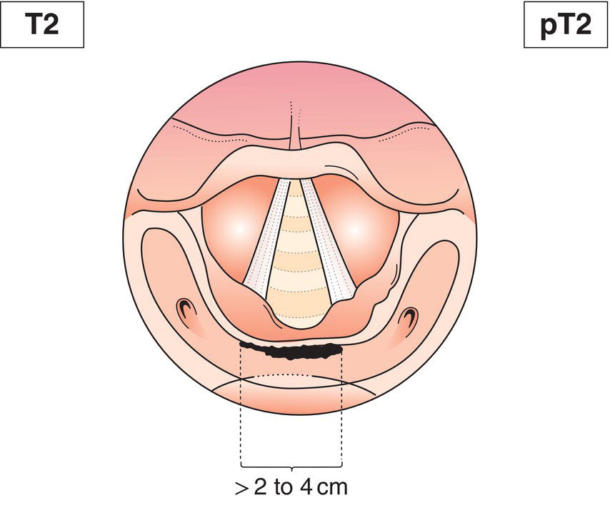 Schematic illustration of tumour invades more than one subsite of hypopharynx or an adjacent site, or measures more than 2 cm but not more than 4 cm in greatest dimension, without fixation of hemilarynx.