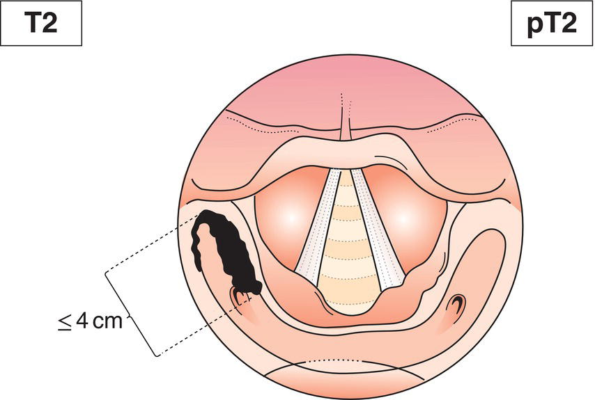 Schematic illustration of tumour invades more than one subsite of hypopharynx or an adjacent site, or measures more than 2 cm but not more than 4 cm in greatest dimension, without fixation of hemilarynx.