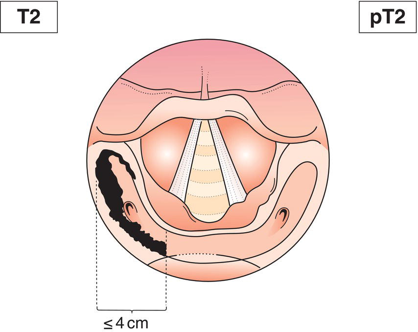 Schematic illustration of tumour invades more than one subsite of hypopharynx or an adjacent site, or measures more than 2 cm but not more than 4 cm in greatest dimension, without fixation of hemilarynx.