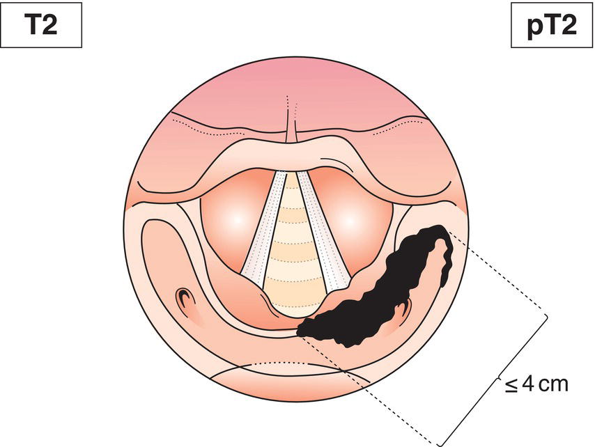 Schematic illustration of tumour invades more than one subsite of hypopharynx or an adjacent site, or measures more than 2 cm but not more than 4 cm in greatest dimension, without fixation of hemilarynx.