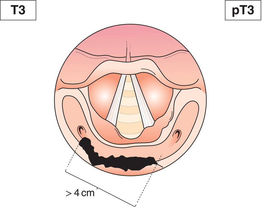 Schematic illustration of tumour more than 4 cm in greatest dimension, or with fixation of hemilarynx or extension to oesophagus.