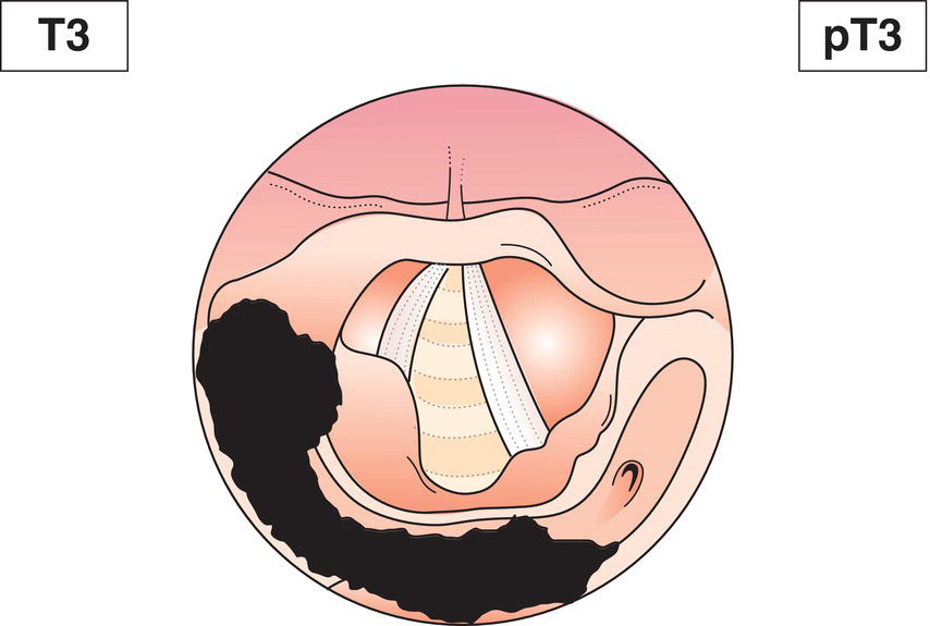 Schematic illustration of tumour more than 4 cm in greatest dimension, or with fixation of hemilarynx or extension to oesophagus.