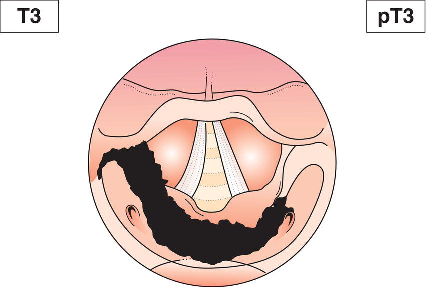 Schematic illustration of tumour more than 4 cm in greatest dimension, or with fixation of hemilarynx or extension to oesophagus.