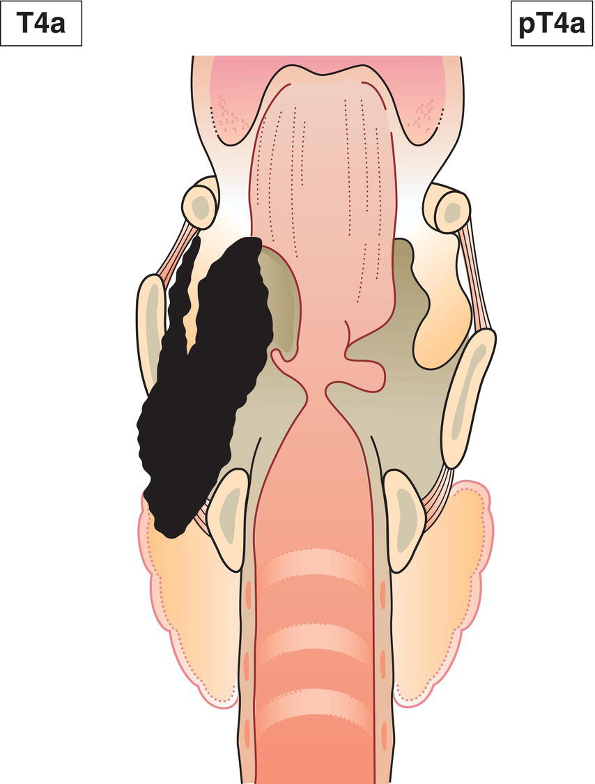 Schematic illustration of tumour invades any of the following: thyroid or cricoid cartilage, hyoid bone, thyroid gland, oesophagus, central compartment soft tissue.