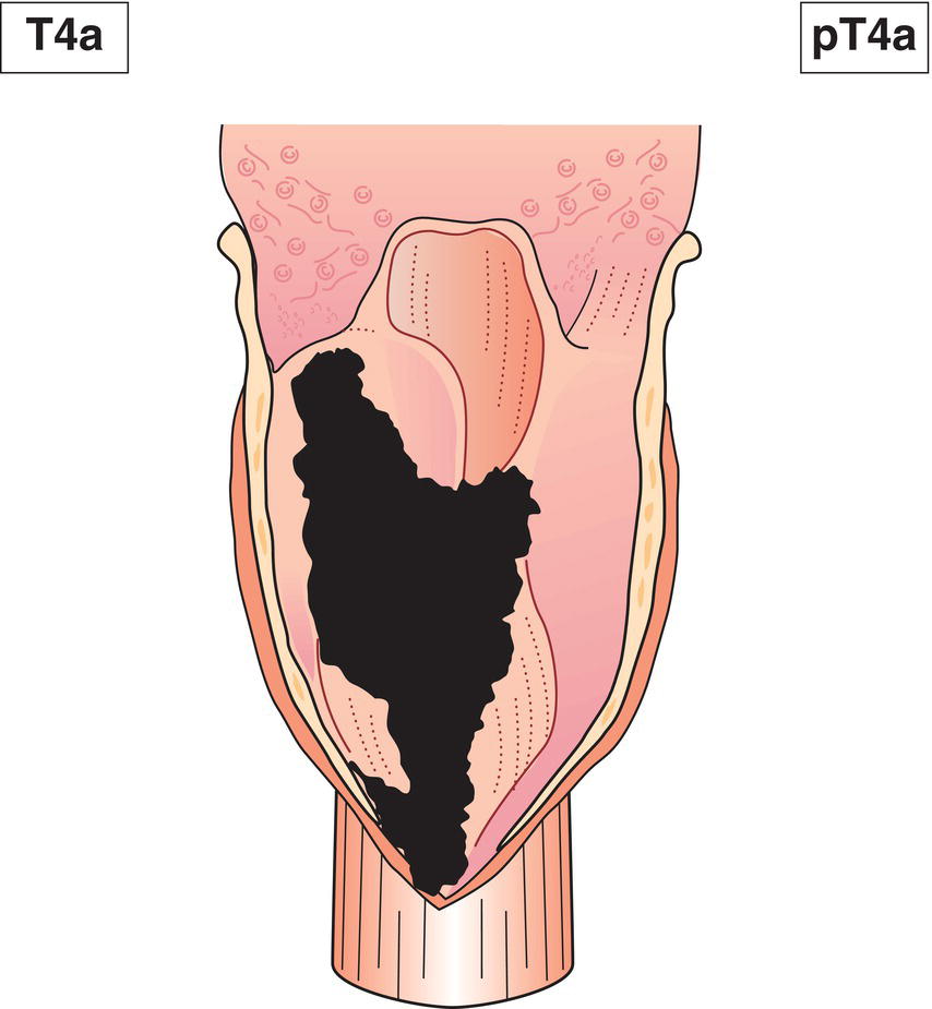 Schematic illustration of tumour invades any of the following: thyroid/cricoid cartilage, hyoid bone, thyroid gland, oesophagus, central compartment soft tissue.