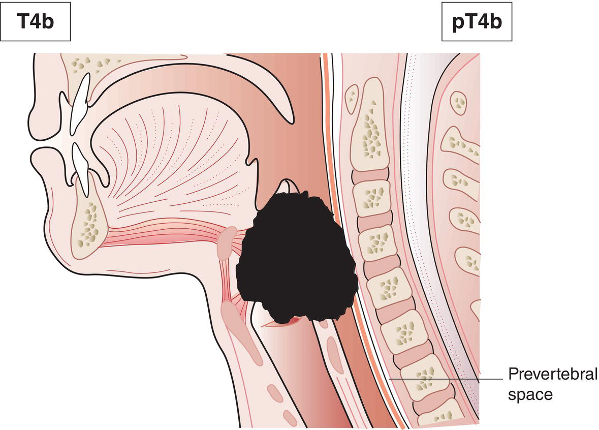 Schematic illustration of tumour invades prevertebral fascia, encases carotid artery or invades mediastinal structures.