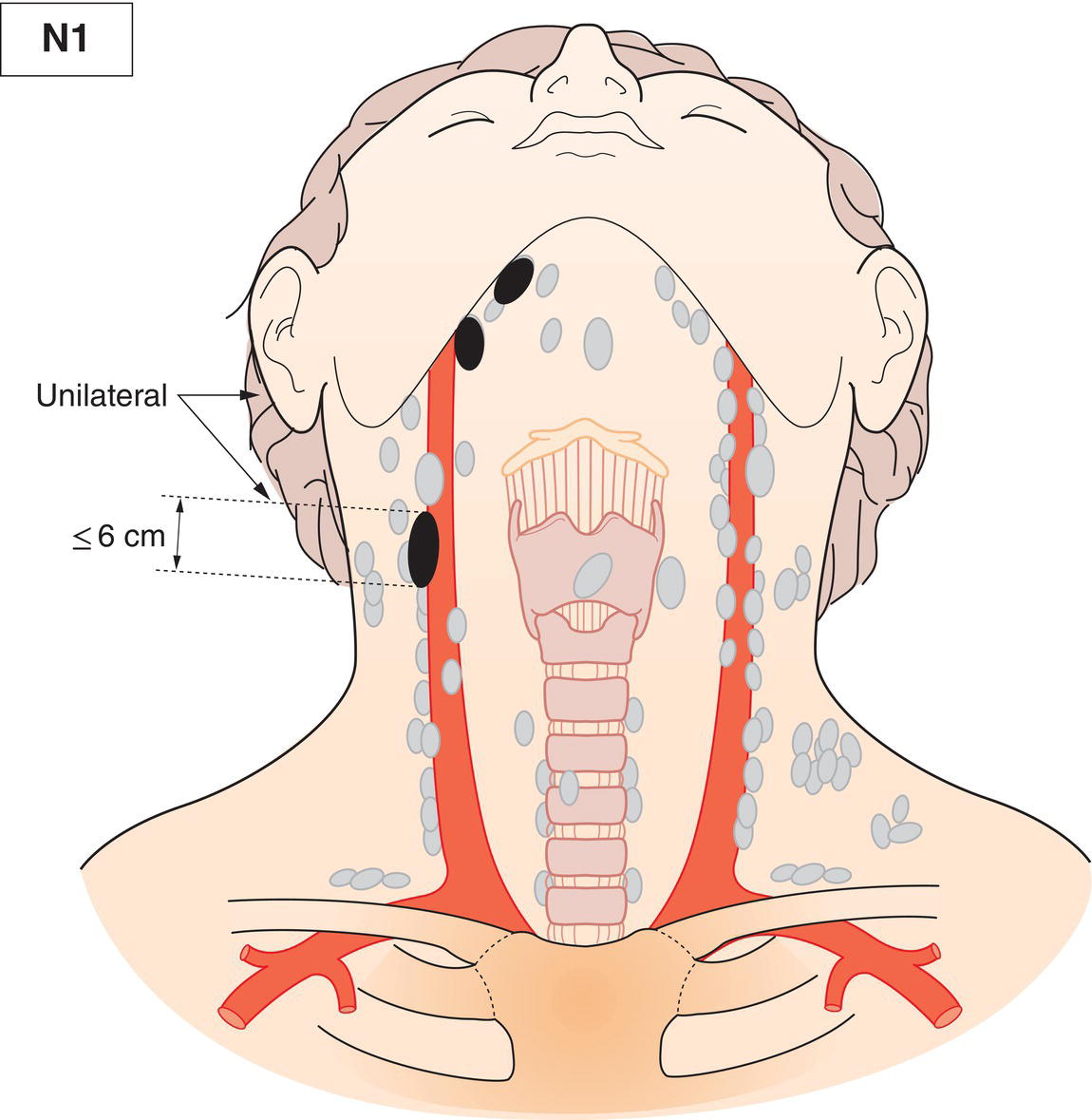 Schematic illustration of Unilateral metastasis, in lymph node(s), all 6 cm or less in greatest dimension.