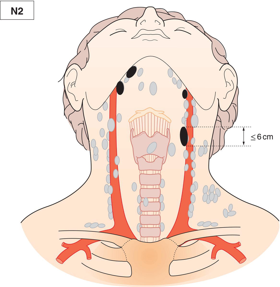 Schematic illustration of Contralateral or bilateral metastasis in lymph node(s), all 6 cm or less in greatest
dimension.