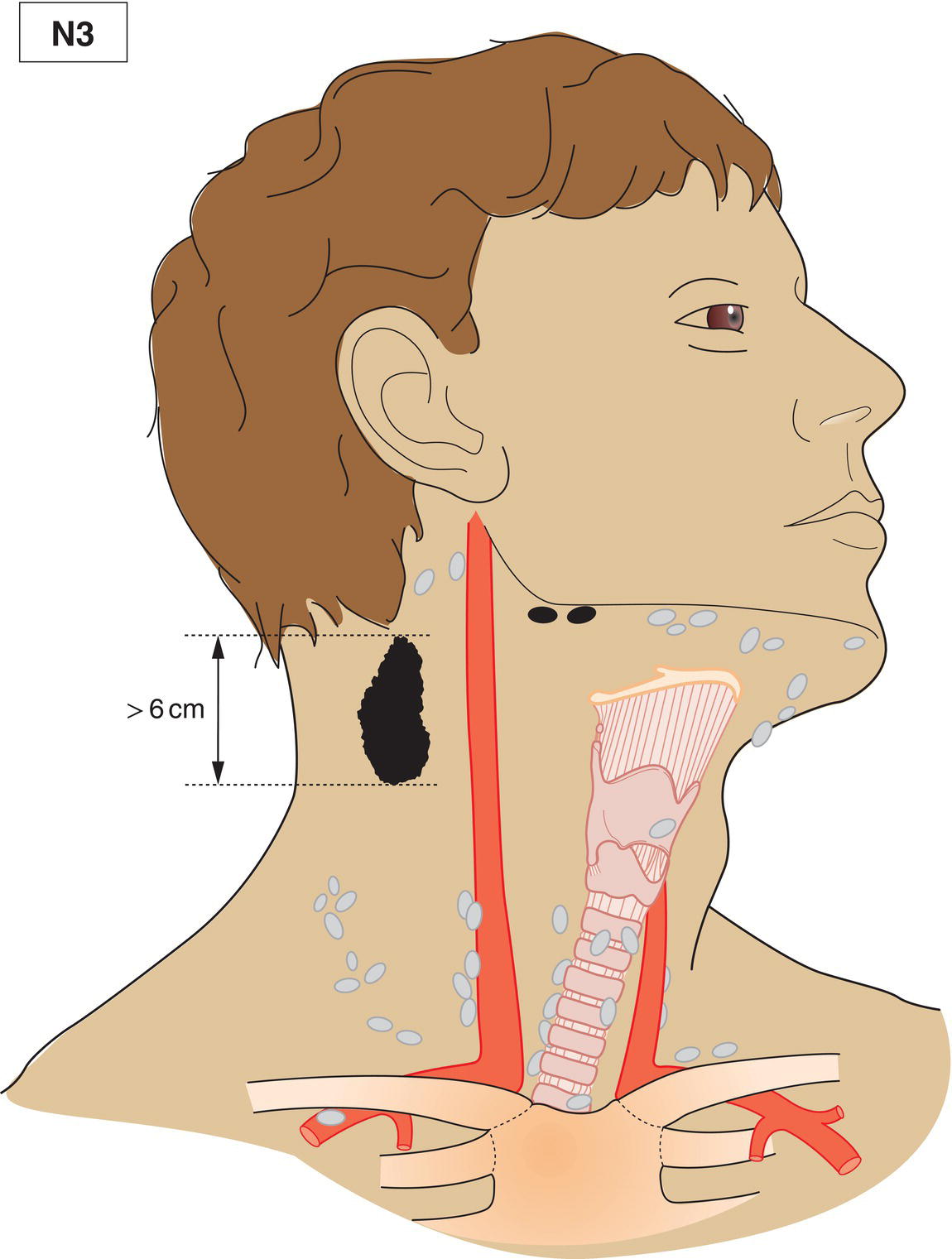 Schematic illustration of Metastasis in lymph node(s) greater than 6 cm in dimension.