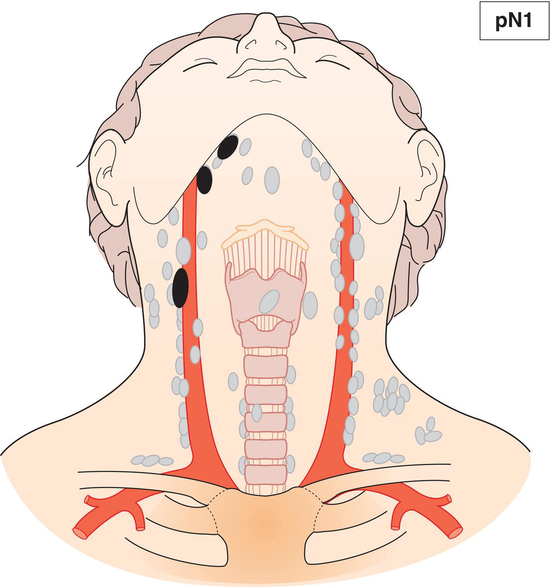 Schematic illustration of Metastasis in 1 to 4 lymph nodes.