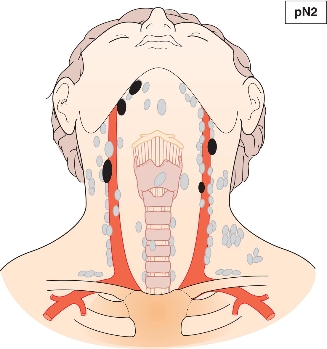 Schematic illustration of Metastasis in 5 or more lymph nodes.