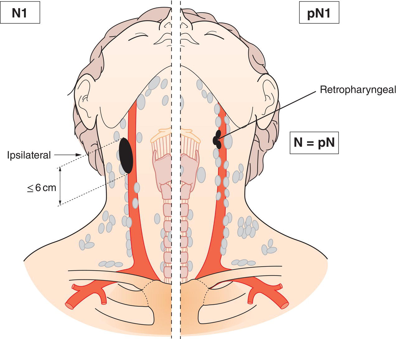 Schematic illustration of Unilateral metastasis, in cervical lymph nodes, and unilateral or bilateral
metastasis in retropharyngeal lymph nodes, 6 cm or less in greatest dimension,
above the caudal border of cricoid cartilage.