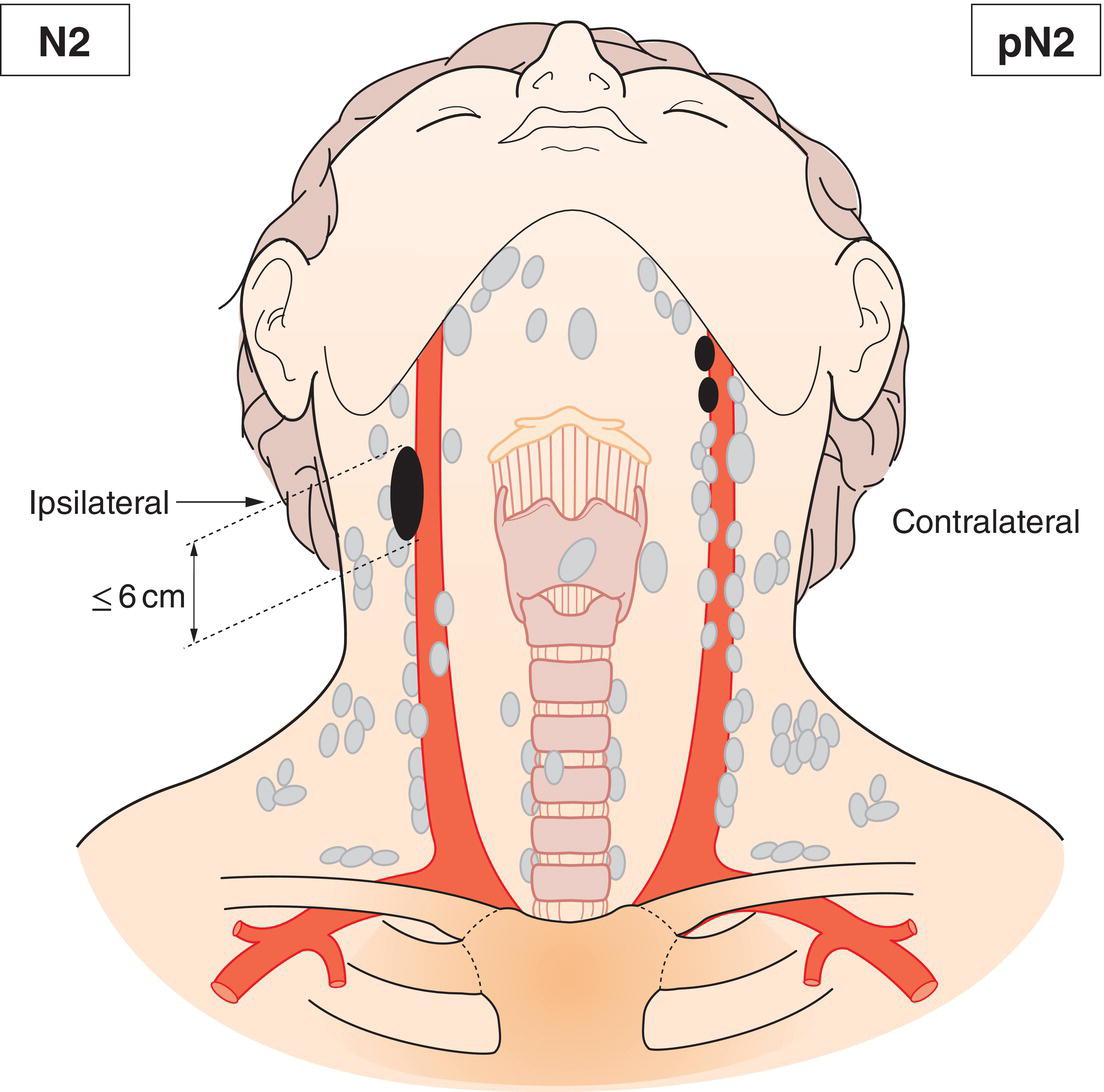 Schematic illustration of Bilateral metastasis in cervical lymph nodes, 6 cm or less in greatest dimension,
above the caudal border of cricoid cartilage.