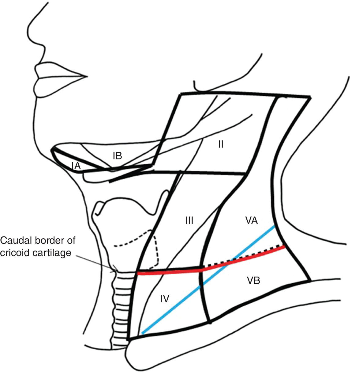 Schematic illustration of Differences in defining criteria between the previous 7th edition and the current 8th edition: replacing the supraclavicular fossa with the lower neck as N3 criteria.