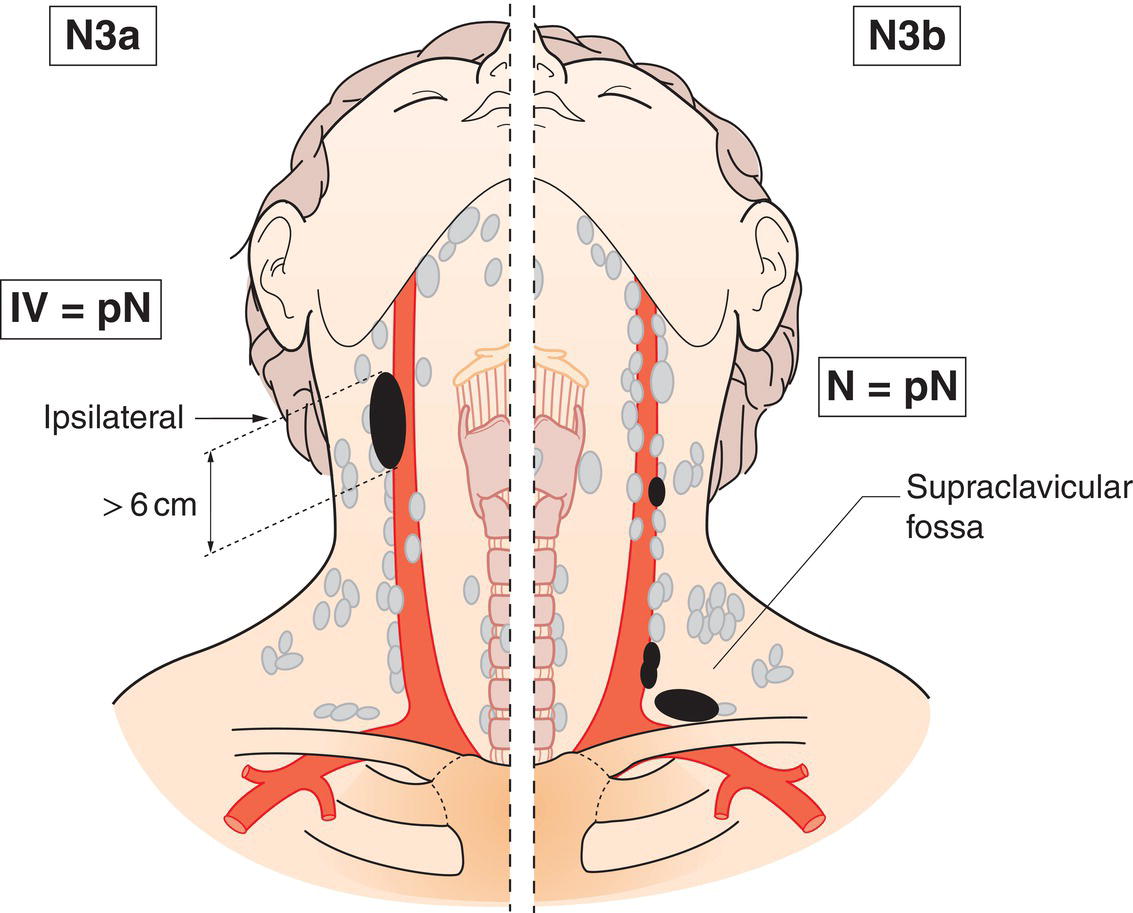 Schematic illustration of Metastasis in cervical lymph nodes greater than 6 cm in dimension and extension below the caudal border of cricoid cartilage.