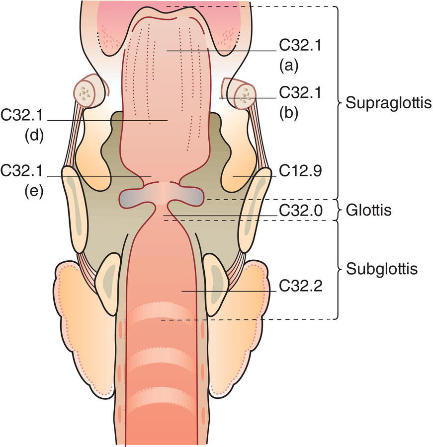 Schematic illustration of head and neck tumours.