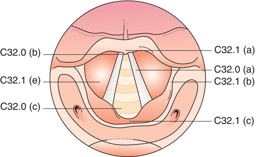 Schematic illustration of head and neck tumours.