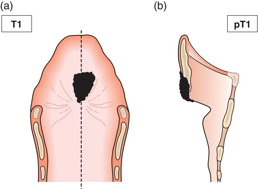 Schematic illustration of tumour limited to one subsite of supraglottis with normal vocal cord mobility.