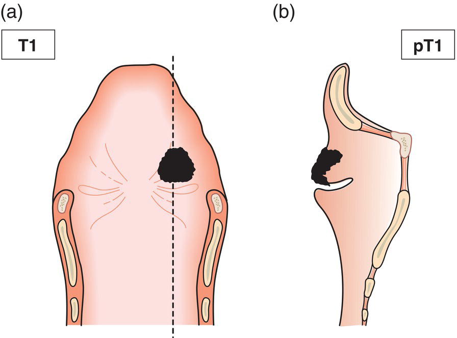 Schematic illustration of tumour limited to one subsite of supraglottis with normal vocal cord mobility.