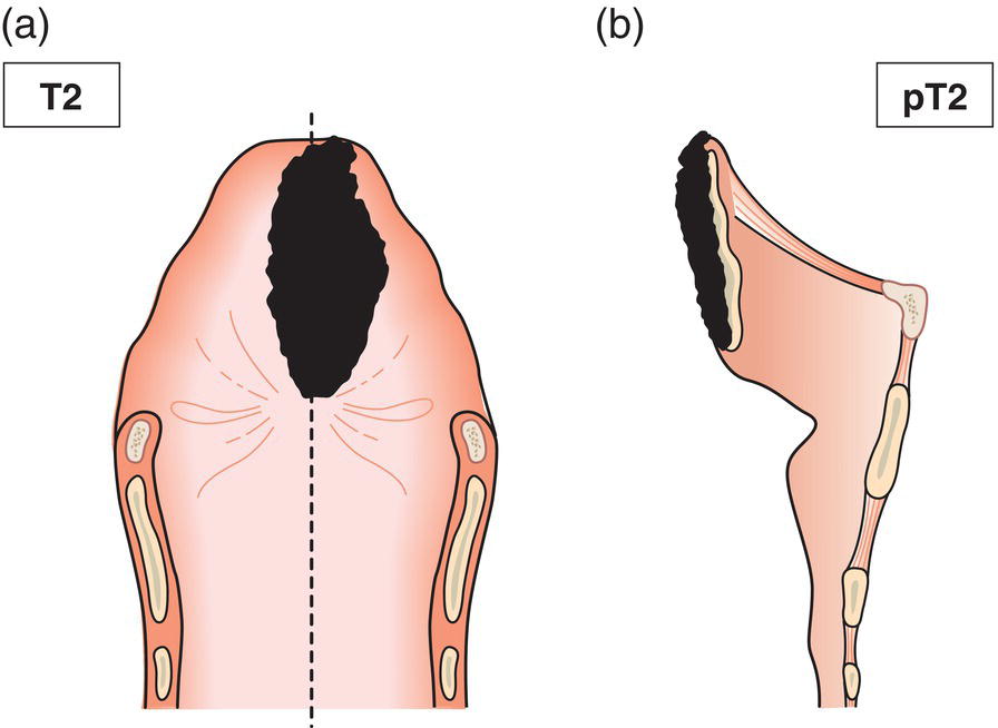 Schematic illustration of tumour invades mucosa of more than one adjacent subsite of supraglottis or glottis or region outside the supraglottis without fixation of the larynx.